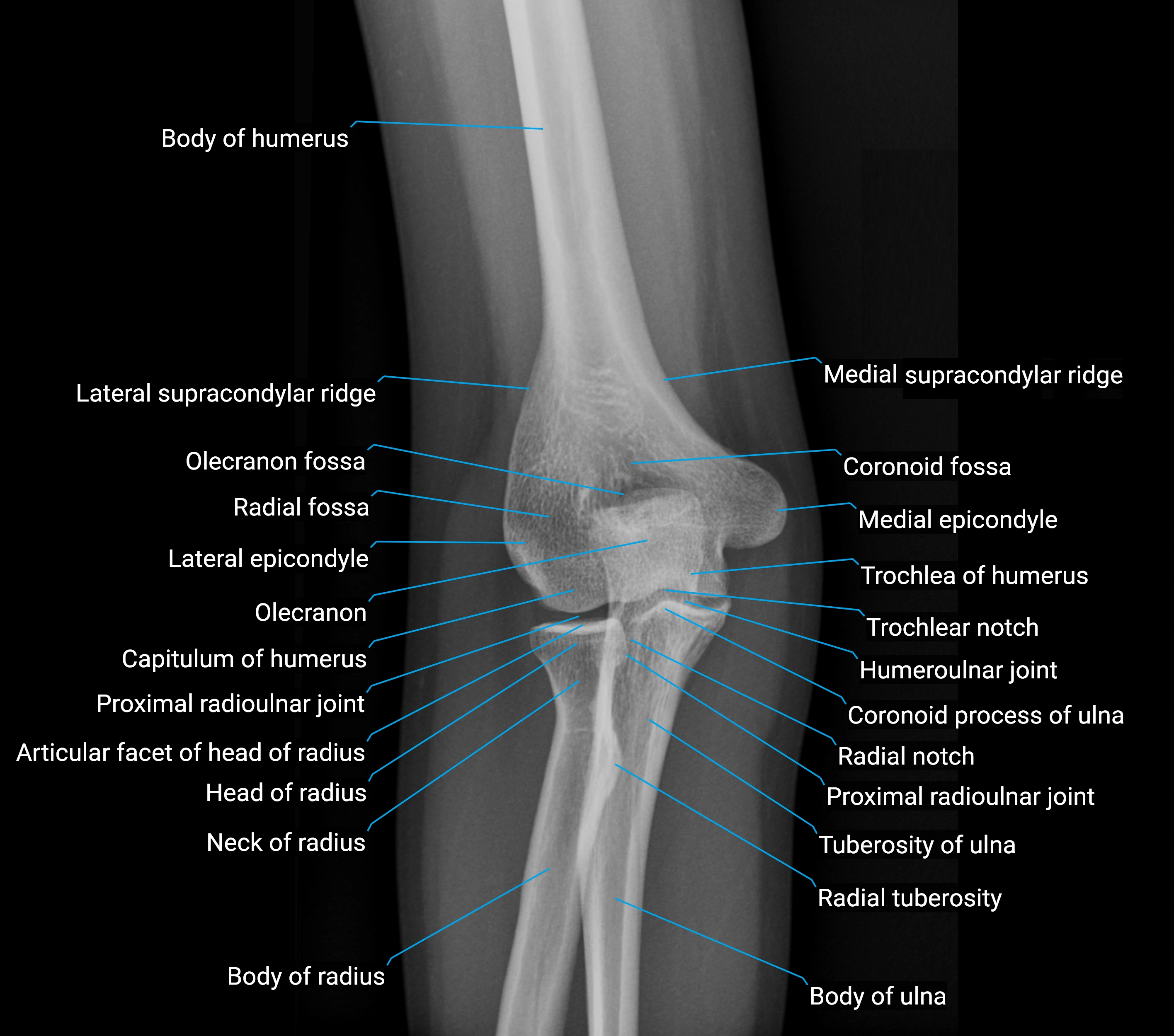 x ray elbow AP anatomy labelled.webp